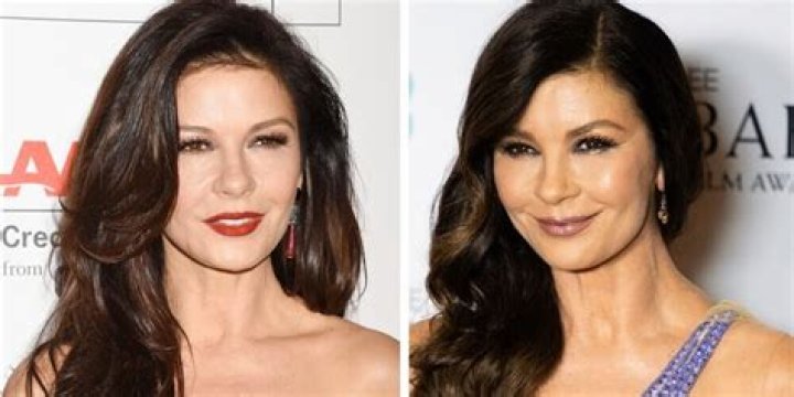 Catherine Zeta Jones Plastic Surgery Disaster Exposed By Top Docs
